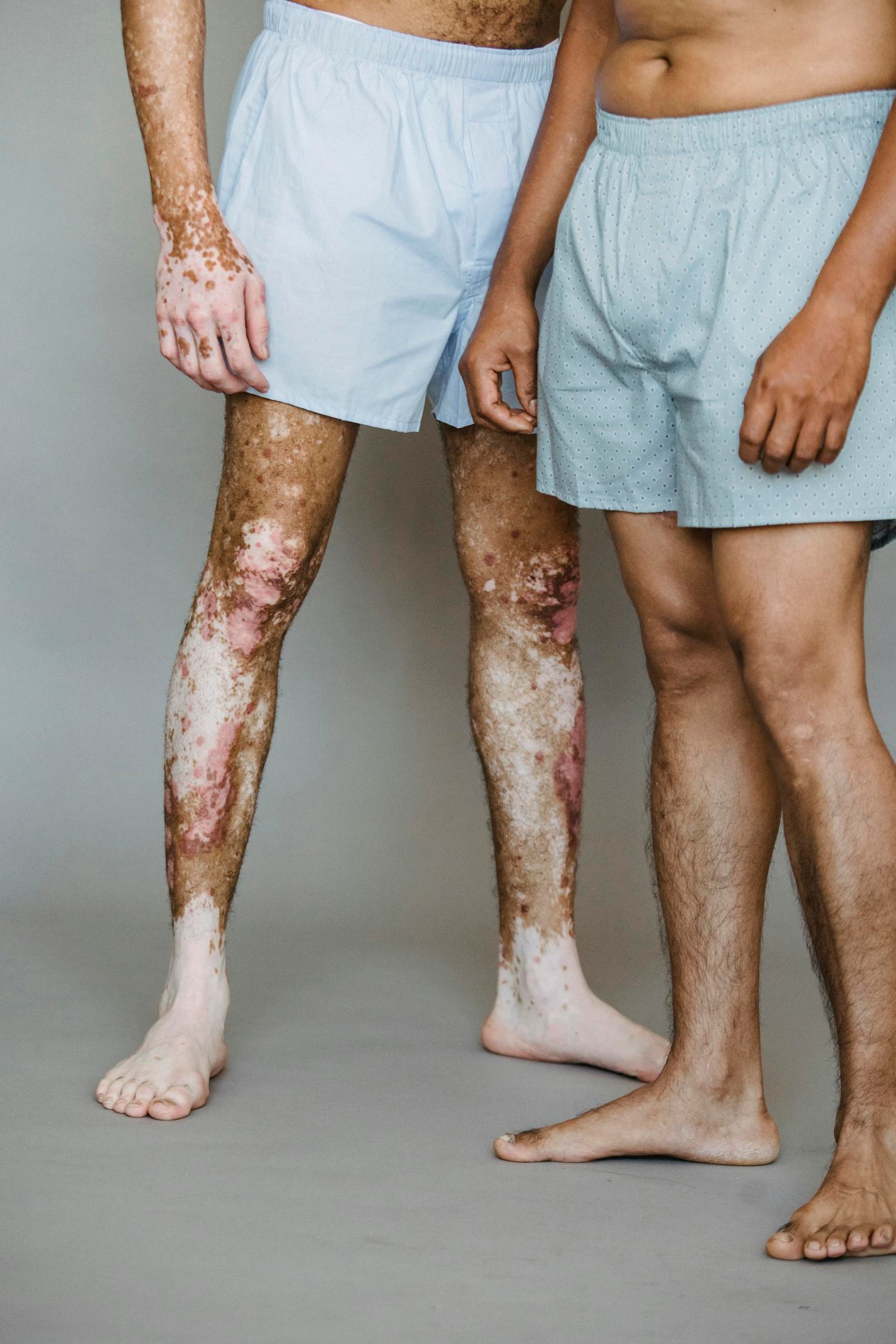 Crop unrecognizable shirtless man in boxer shorts living with vitiligo skin standing near man in underwear in light studio